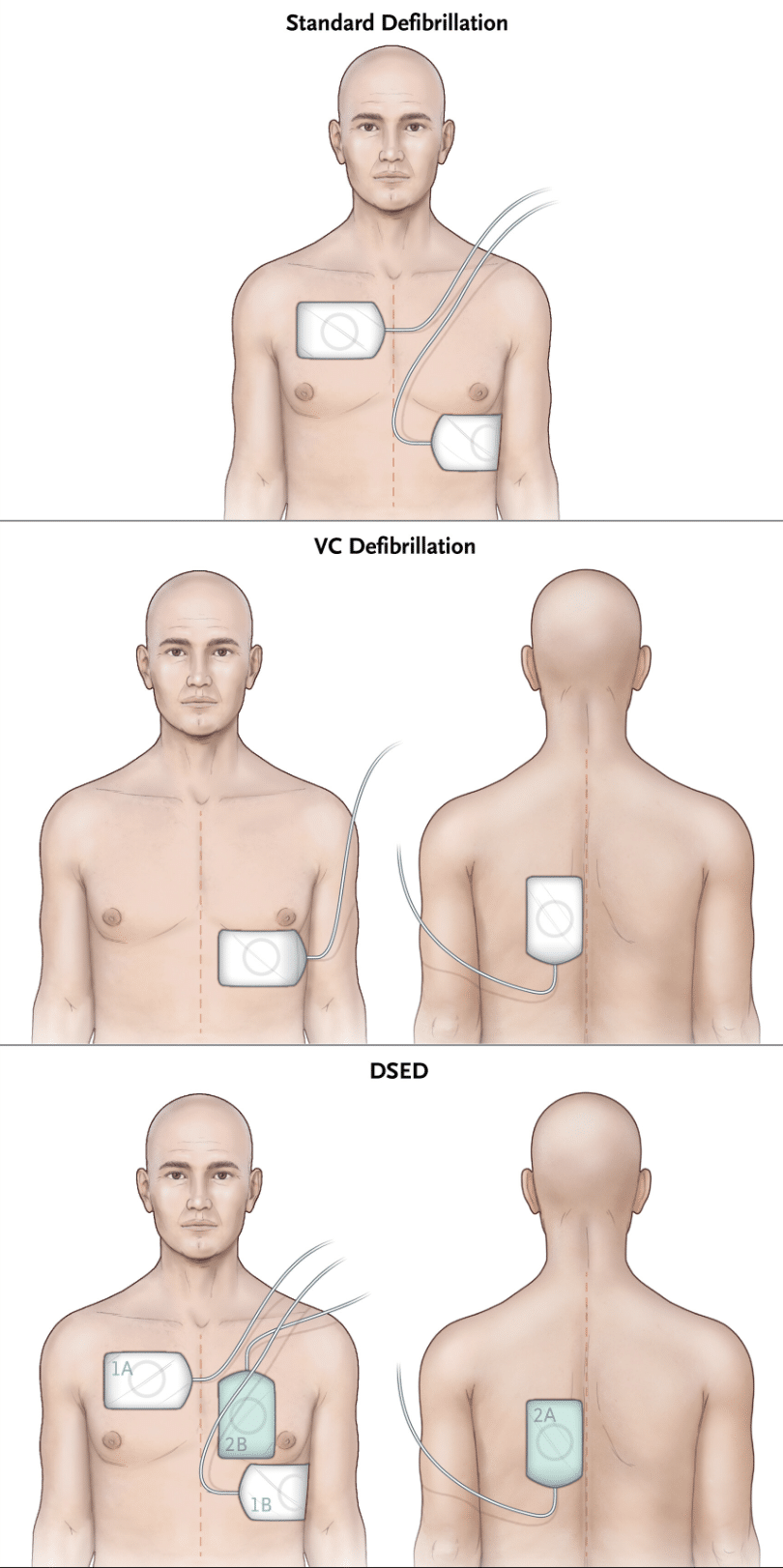 Arrêt cardiaque et double défibrillation : protocole de l'étude DOSE-VF